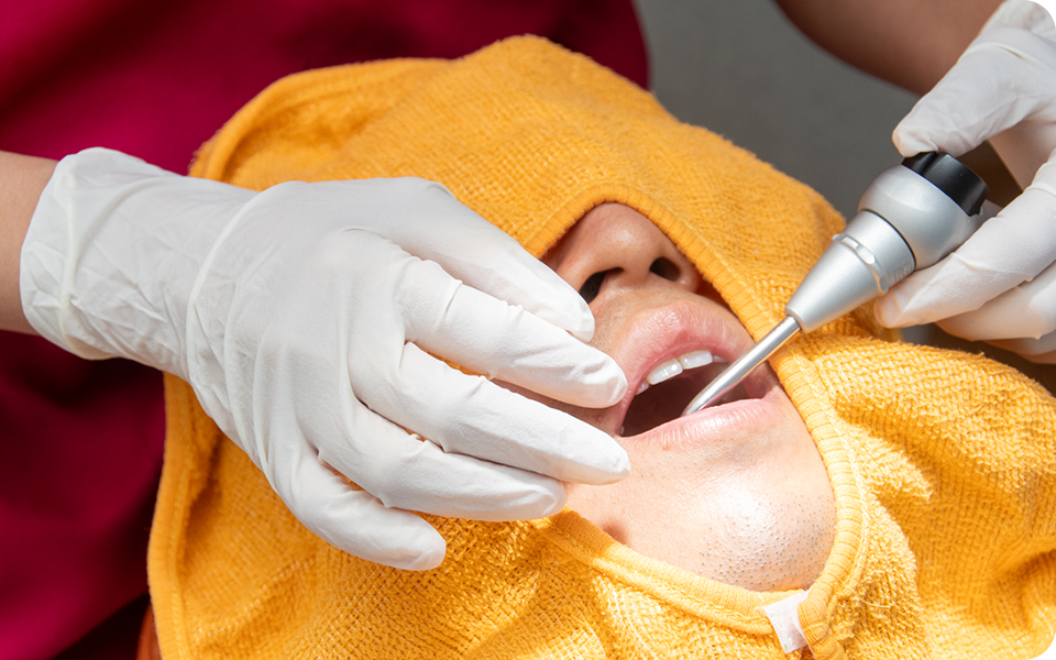 ダイレクトボンディング