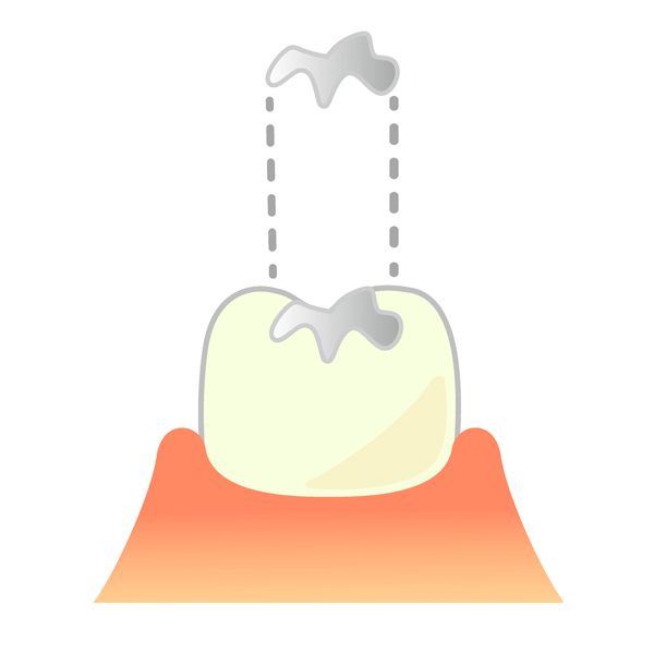 虫歯の進行に応じた治療