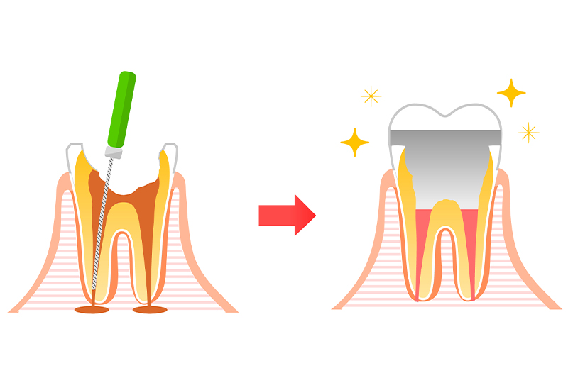 虫歯の進行に応じた治療