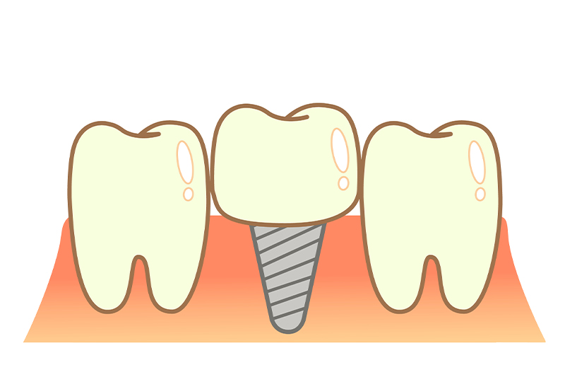 虫歯の進行に応じた治療