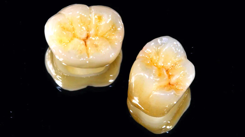 セラミッククラウン（ジルコニア・e.max）