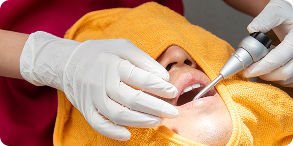 ダイレクトボンディング